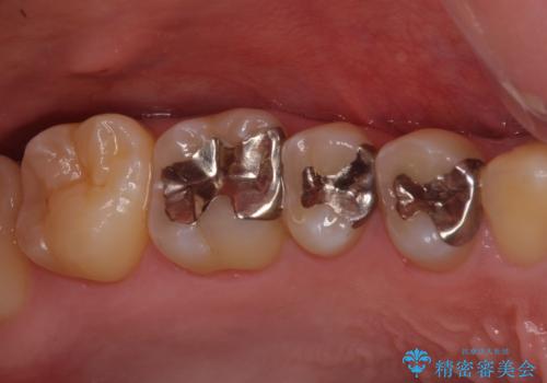 銀歯を白くしたい セラミックによる審美歯科治療の治療前
