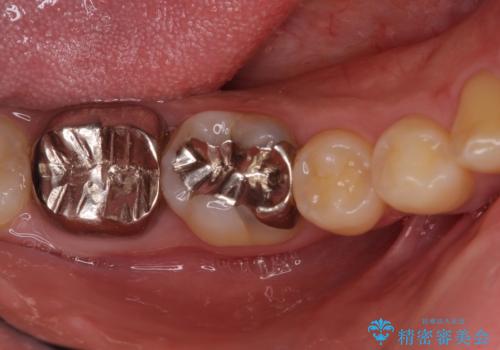 銀歯を白くしたい セラミックによる審美歯科治療の治療前