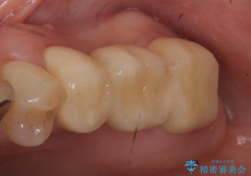 オールセラミッククラウン　抜歯になった奥歯の欠損補綴の治療後