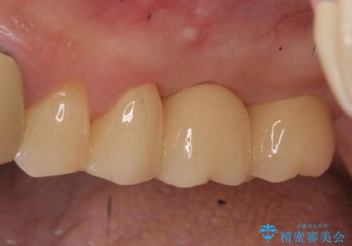 オールセラミッククラウン　抜歯になった奥歯の欠損補綴の症例 治療後