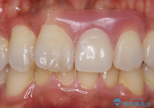 ノンクラスプデンチャー(バルプラスト)の治療後