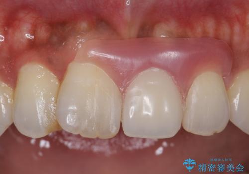 ノンクラスプデンチャー(バルプラスト)の症例 治療後