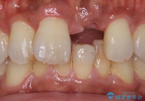 ノンクラスプデンチャー(バルプラスト)の治療前