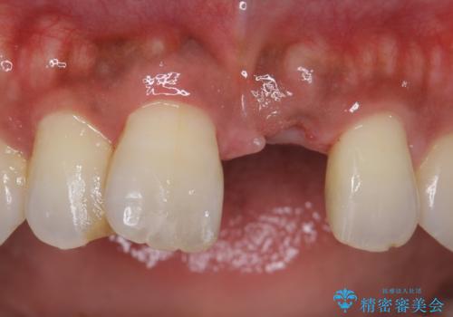 ノンクラスプデンチャー(バルプラスト)の症例 治療前