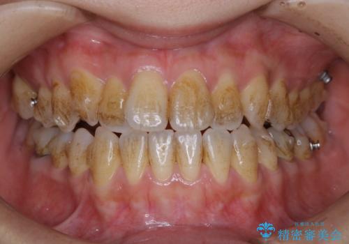 インビザライン矯正治療中にこびりついた着色をPMTCで綺麗にの治療前