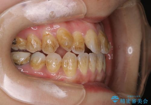 インビザライン矯正治療中にこびりついた着色をPMTCで綺麗にの治療前
