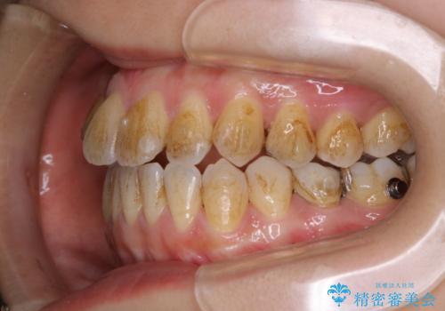 インビザライン矯正治療中にこびりついた着色をPMTCで綺麗に