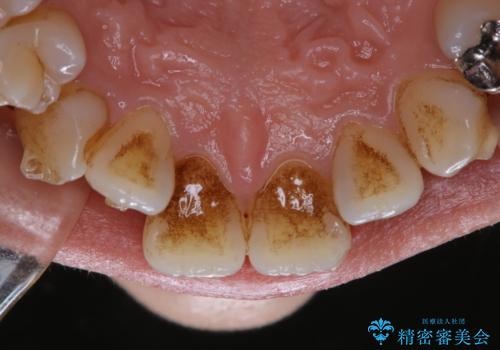 インビザライン矯正治療中にこびりついた着色をPMTCで綺麗にの治療前