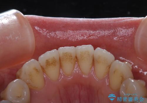 インビザライン矯正治療中にこびりついた着色をPMTCで綺麗にの治療前