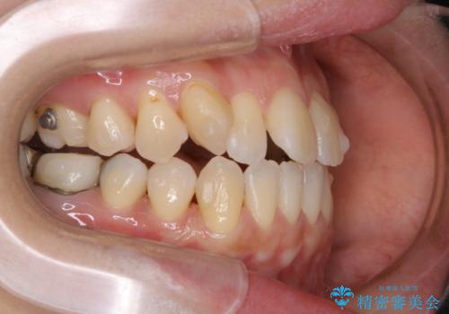 インビザライン矯正治療中にこびりついた着色をPMTCで綺麗にの治療後