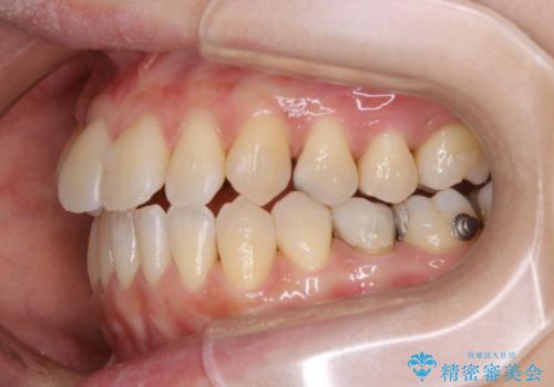 インビザライン矯正治療中にこびりついた着色をPMTCで綺麗にの治療後