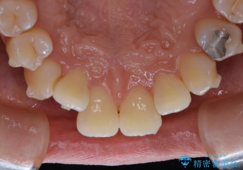 インビザライン矯正治療中にこびりついた着色をPMTCで綺麗にの治療後