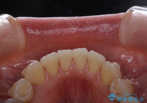 インビザライン矯正治療中にこびりついた着色をPMTCで綺麗にの治療後