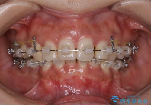 総合歯科ならではのメリット　矯正中にもPMTCをの治療前