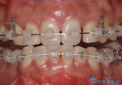 総合歯科ならではのメリット　矯正中にもPMTCをの治療前