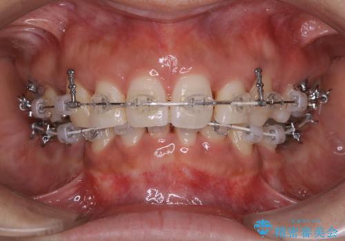 総合歯科ならではのメリット　矯正中にもPMTCをの治療後