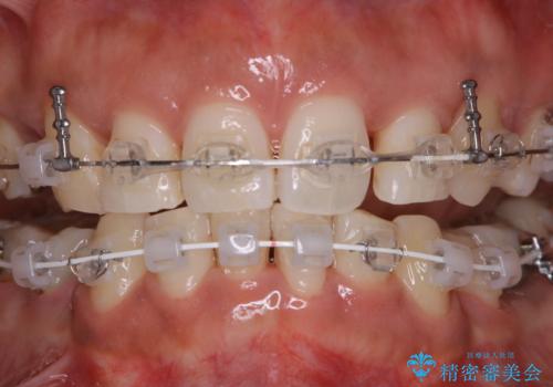 総合歯科ならではのメリット　矯正中にもPMTCをの症例 治療後