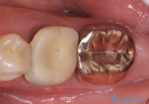 オールセラミッククラウン 咬むと痛む奥歯の治療の治療前