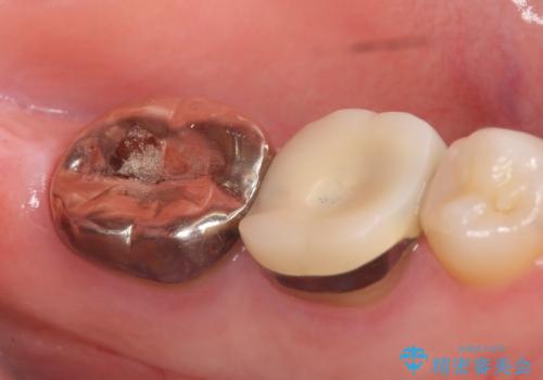 オールセラミッククラウン 咬むと痛む奥歯の治療の治療前