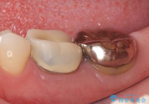 オールセラミッククラウン 咬むと痛む奥歯の治療の症例 治療前