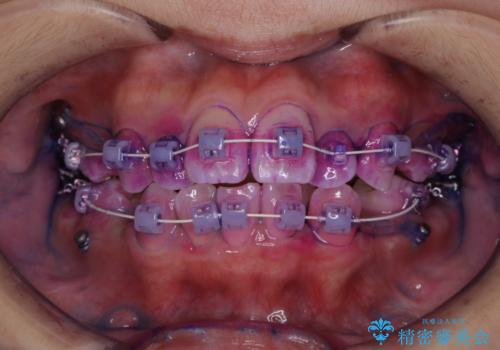 ワイヤー矯正中にPMTCでオーラルケアの症例 治療前