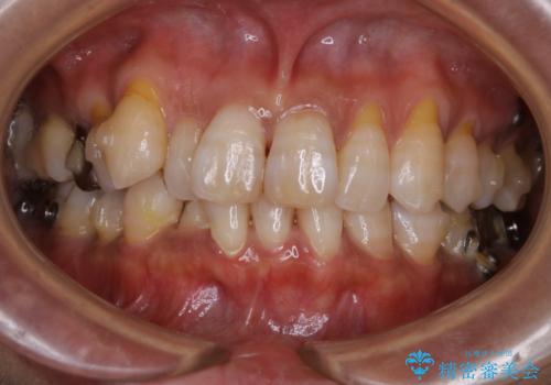 INVISALIGN治療中のPMTC