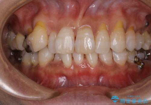 INVISALIGN治療中のPMTCの治療後