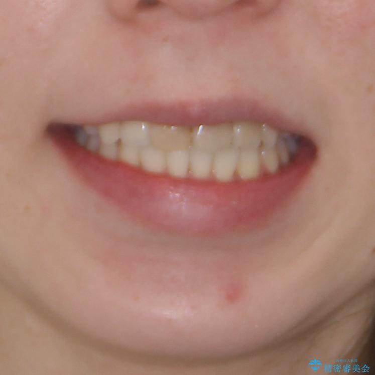 抜歯矯正の後戻り インビザラインによるオープンバイトの再矯正の治療後(顔貌)