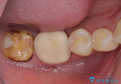 奥歯の壊れたり汚れたりしたクラウン　オールセラミッククラウンによる審美歯科治療　の症例 治療前