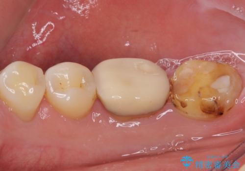 奥歯の壊れたり汚れたりしたクラウン　オールセラミッククラウンによる審美歯科治療　の治療前