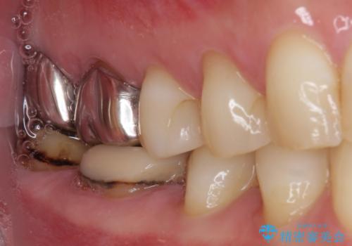 奥歯の壊れたり汚れたりしたクラウン オールセラミッククラウンによる審美歯科治療 の治療前