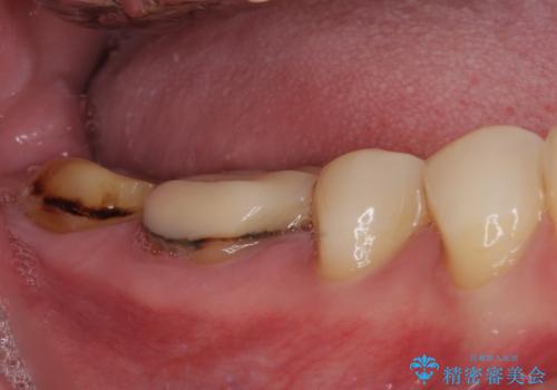 奥歯の壊れたり汚れたりしたクラウン　オールセラミッククラウンによる審美歯科治療　の治療前