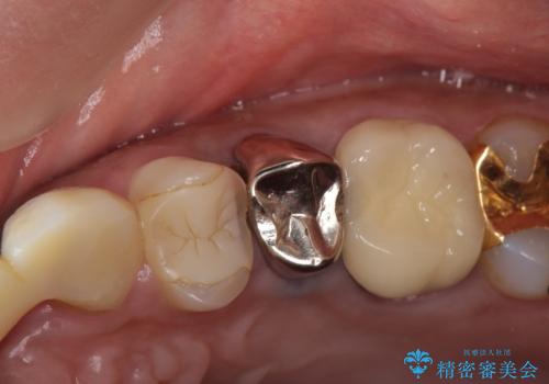 オールセラミッククラウン 根管治療のやり直しの治療前