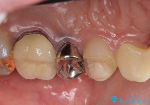 オールセラミッククラウン 根管治療のやり直しの治療前