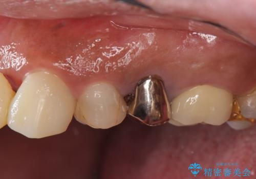 オールセラミッククラウン 根管治療のやり直しの治療前