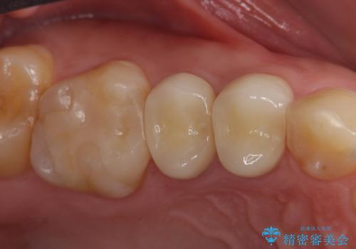 セラミック治療　銀歯を白い歯への症例 治療後