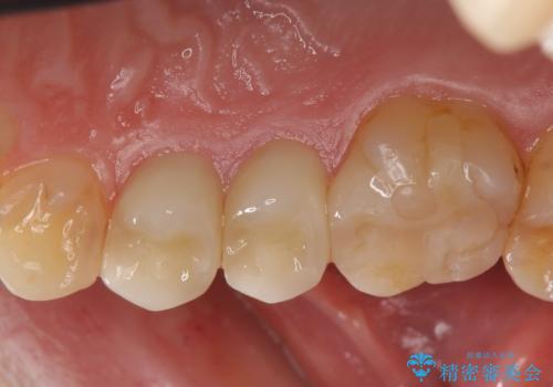 セラミック治療　銀歯を白い歯へ