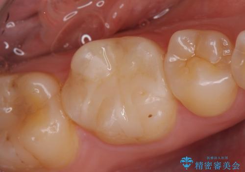 セラミックインレー　気になる銀歯を白い歯への治療後