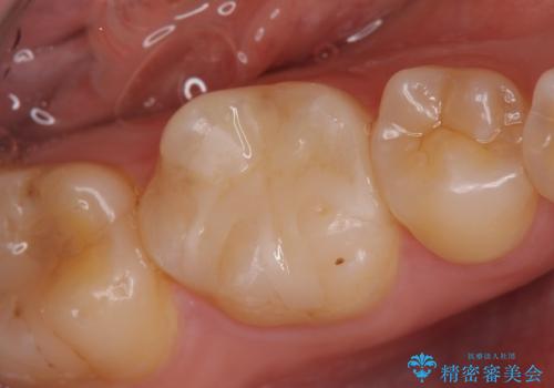 セラミックインレー 気になる銀歯を白い歯へ