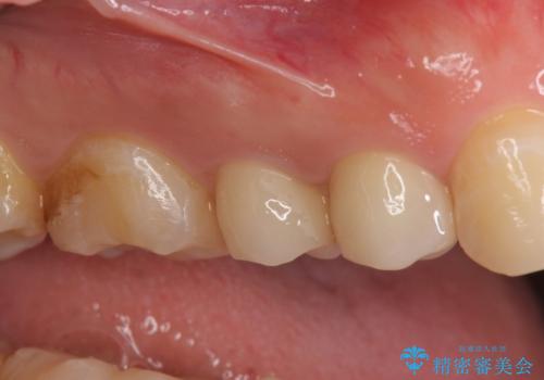 セラミック治療　銀歯を白い歯への治療後