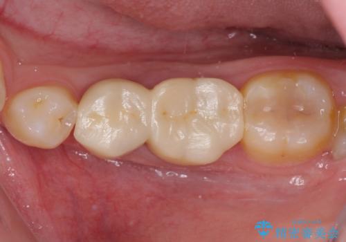深い虫歯で歯茎が腫れる 部分矯正を用いたむし歯治療の治療前