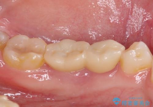 深い虫歯で歯茎が腫れる　部分矯正を用いたむし歯治療の治療前