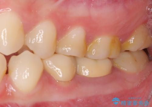 深い虫歯で歯茎が腫れる 部分矯正を用いたむし歯治療の治療前