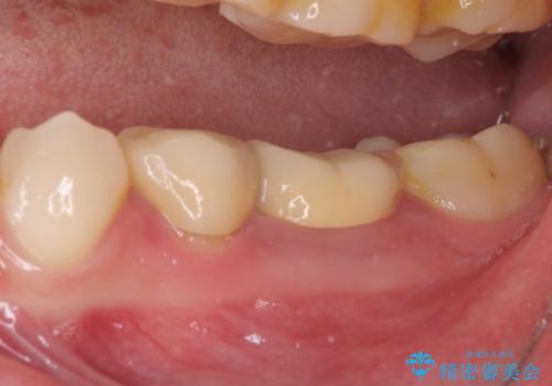 深い虫歯で歯茎が腫れる　部分矯正を用いたむし歯治療の症例 治療前