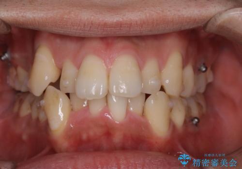 マウスピース矯正中にPMTCの治療前