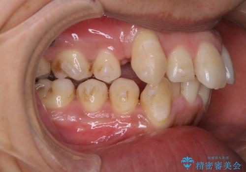 マウスピース矯正中にPMTCの治療前