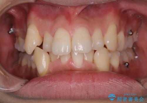 マウスピース矯正中にPMTCの治療後