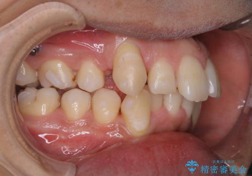 マウスピース矯正中にPMTCの治療後