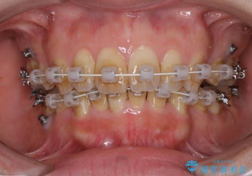 ワイヤー矯正治療中のPMTC60分コースでステインをキレイにの治療前