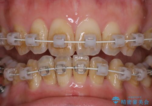 ワイヤー矯正治療中のPMTC60分コースでステインをキレイにの治療前